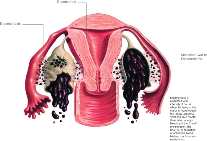endometriosis Endometriosis - Infertility Cause