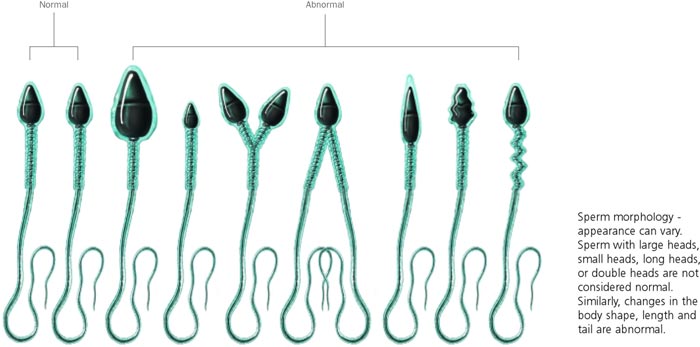 sperm-morphology-maleinfertility-Coastal-IVF Male infertility - sperm morphology - Coastal IVF