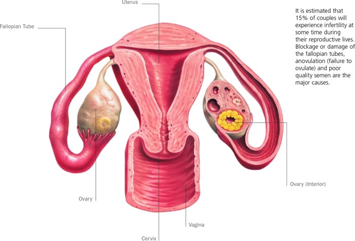 tubal-uterine-causes