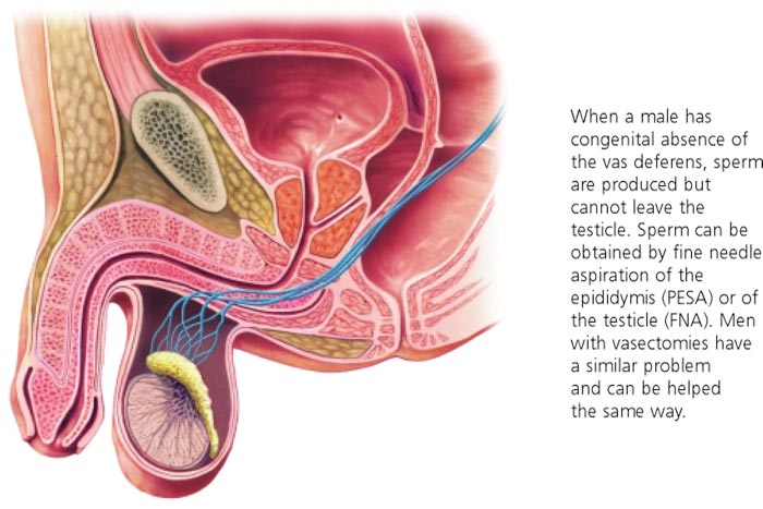 Vasectomy - Reversal -Coastal IVF Sunshine Coast