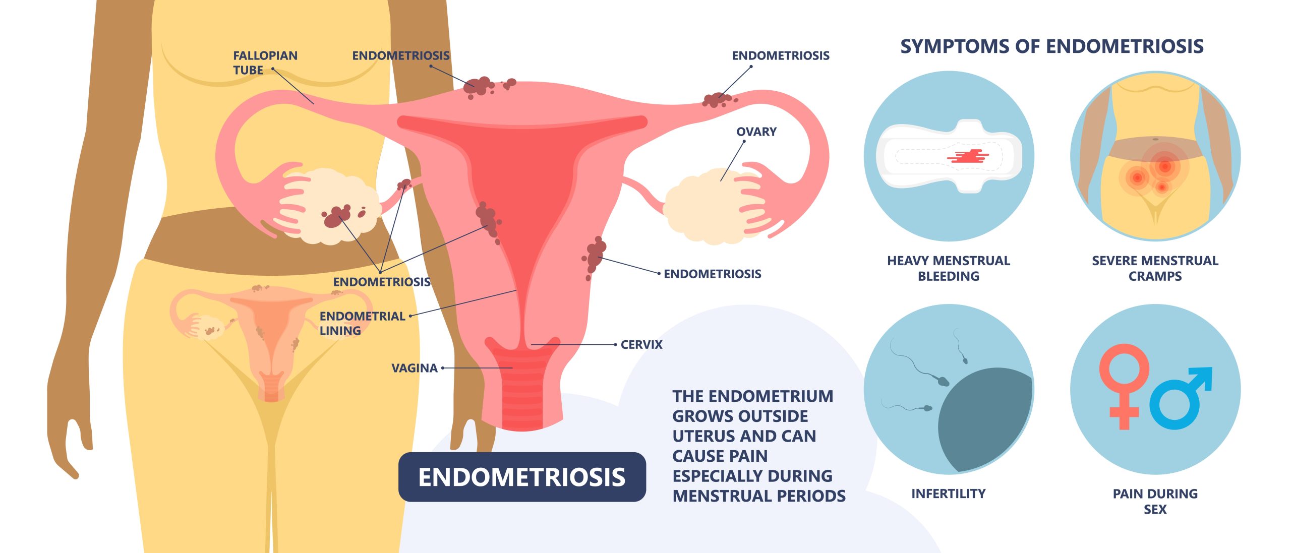 Endometriosis: how does it happen?