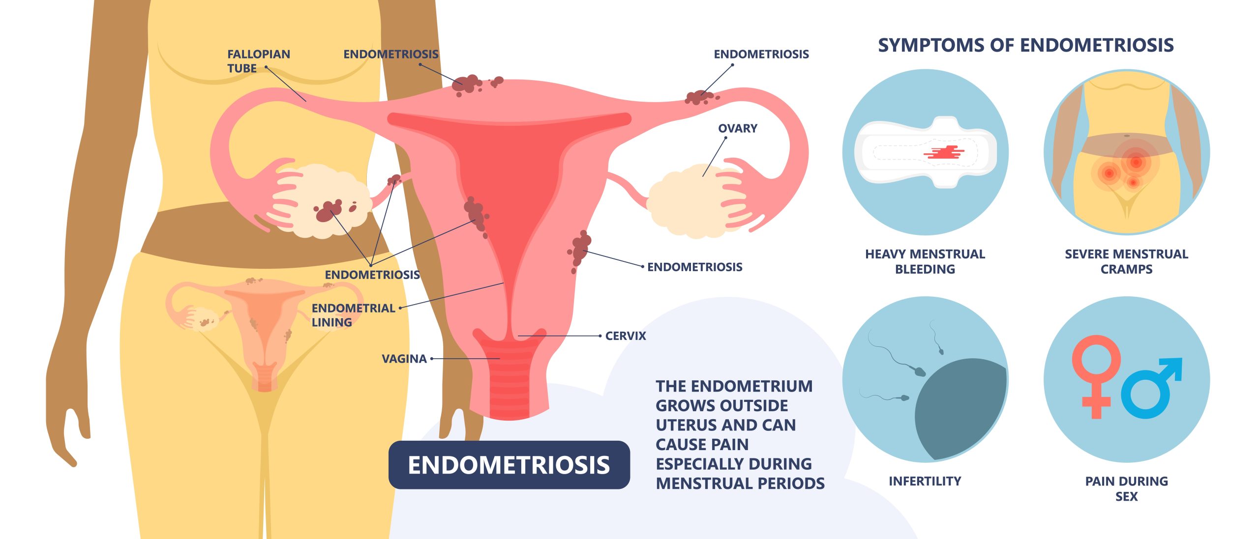 Endometriosis,Pain,Pcos,Tissue,Cancer,Cyst,Pelvic,Ovary,Lining,Tissue